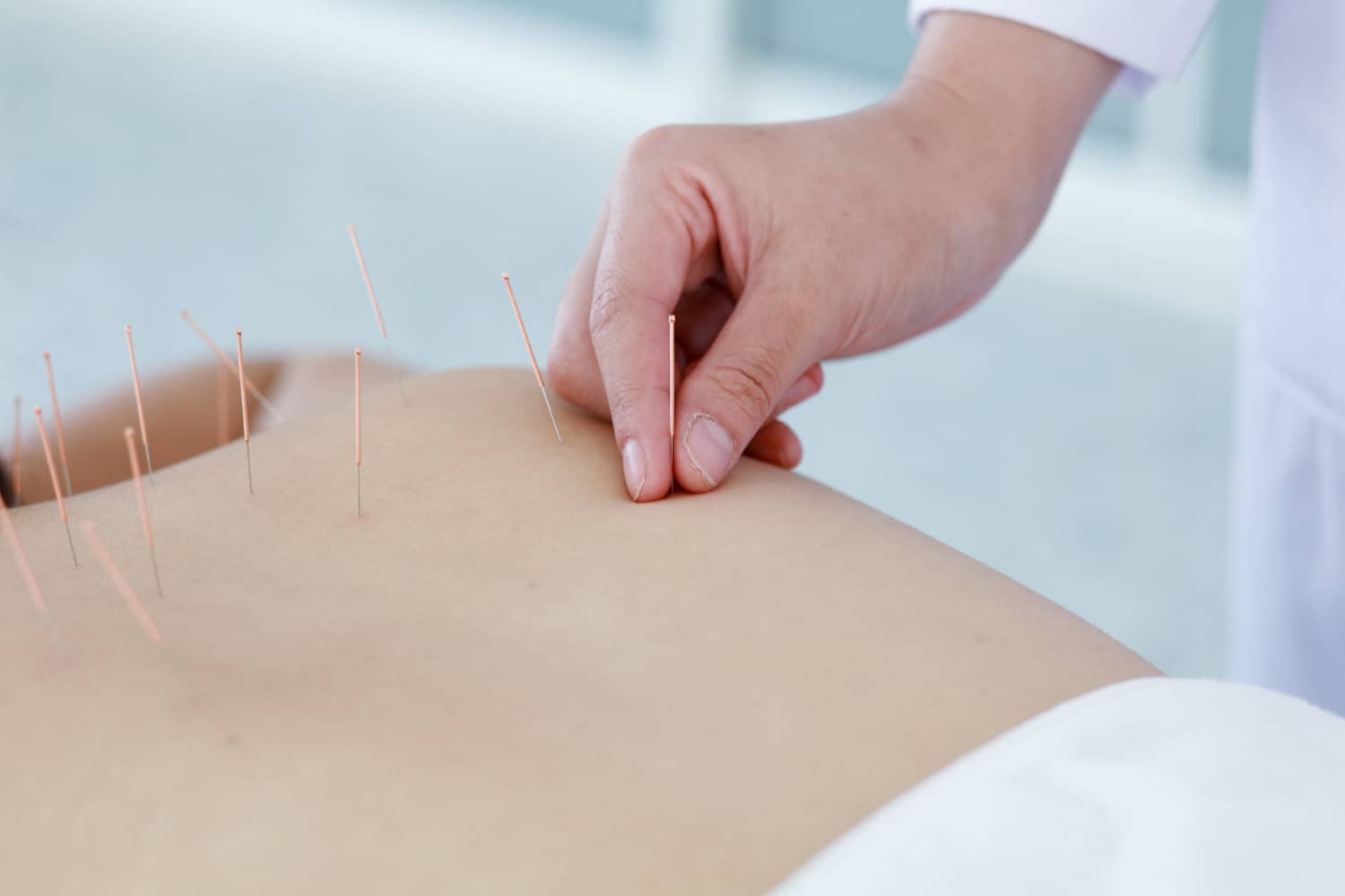 Acupuncture & Treatments