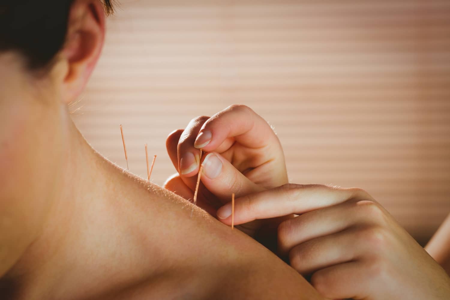 young-woman-getting-acupuncture-treatment